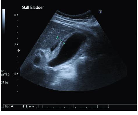 Cholecystitis with thickened and oedematous gallbladder wall, without... | Download Scientific ...