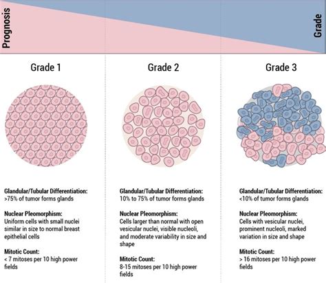 Staging & Grade - Breast Cancer | Johns Hopkins Pathology