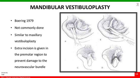 Vestibuloplasty- ridge extension procedures