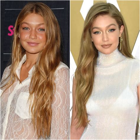 Gigi Hadid Plastic Surgery - Milano Klinik