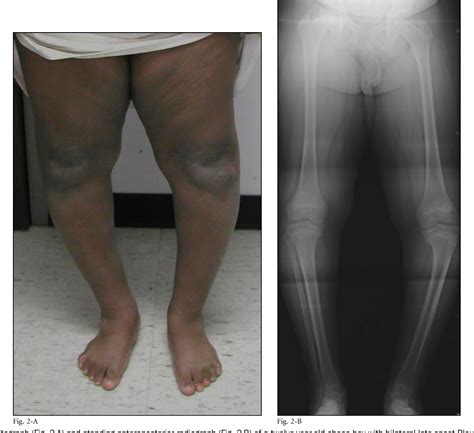 Figure 4 from Blount disease. | Semantic Scholar