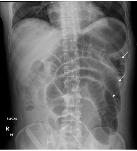 Small Bowel Obstruction Air Fluid Levels