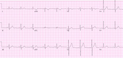 T-wave INVERSION mnemonic | ECG Cases | Emergency Medicine Cases