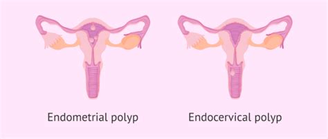 What is the difference between an endometrial polyp and an endocervical polyp?