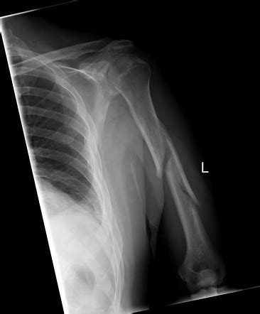 Comminuted Fracture X Ray