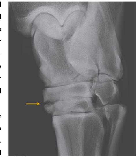 Figure 4 from Radiographic study of bone spavin in Lusitano Horses | Semantic Scholar