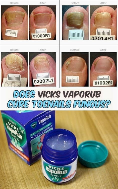 Read directions about Vicks VapoRub and its benefits on curing toenail fungus. | Remedios para ...