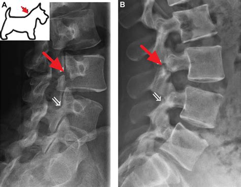 Spondylolysis causes, symptoms, diagnosis, treatment & prognosis