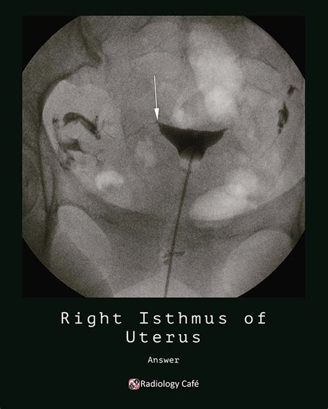 Correct answer: Right isthmus of uterus Share this post in your story! Question from the mock ...