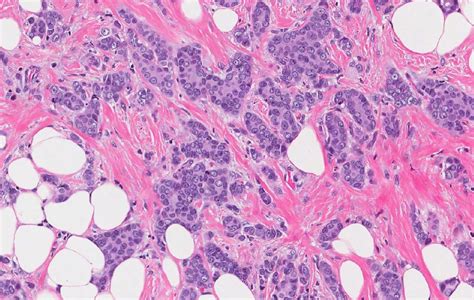 Invasive Lobular Carcinoma