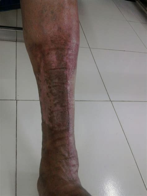 Cellulitis of the leg - Diabetic Foot Clinic