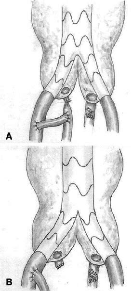 Intentional Internal Iliac Artery Occlusion in Endovascular Repair of ...