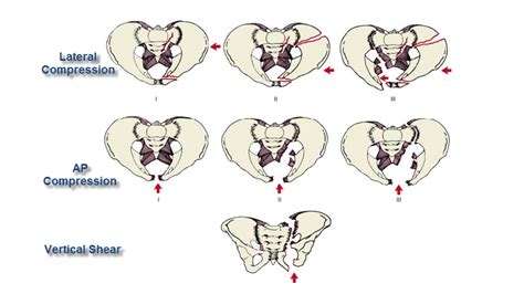 Pelvic Vertical Shear Fractures – Core EM