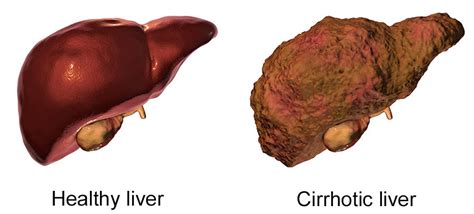 Cirrhosis Of The Liver Caused By Diabetes - DiabetesWalls