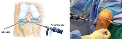 Meniscus Tears - OrthoInfo - AAOS