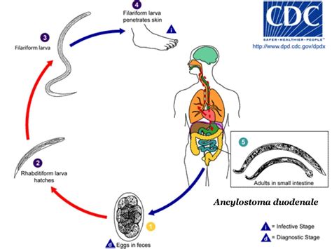 Ancylostomiasis