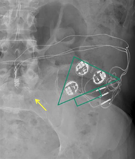 sacral nerve stimulation - Questions and Answers in MRI