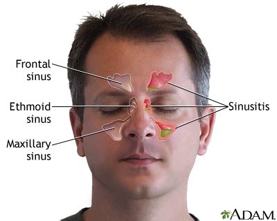 Sinus Infection (Sinusitis) - Symptoms and Causes | Penn Medicine