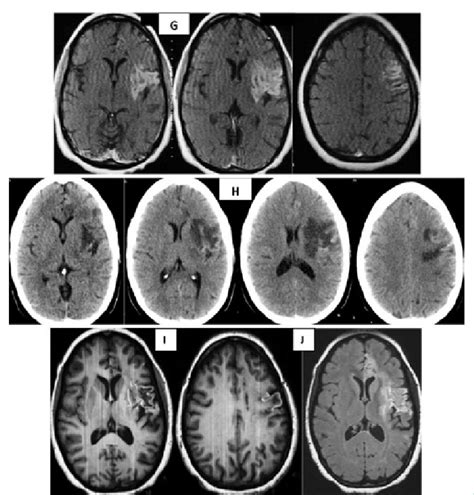 G-J: MRI performed 40 days after the previous CT scan show laminar... | Download Scientific Diagram