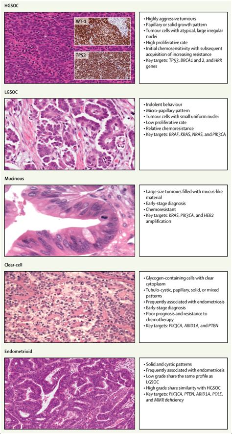 Epithelial ovarian cancer - The Lancet