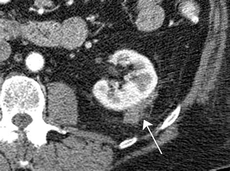 Differential Diagnosis of Perinephric Masses on CT and MRI | AJR