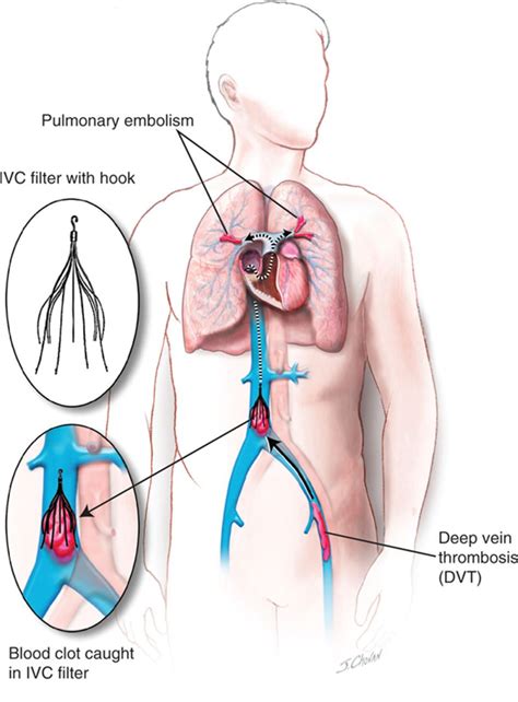 Inferior Vena Cava Filters, May-Thurner Syndrome, and Vein Stents | Circulation