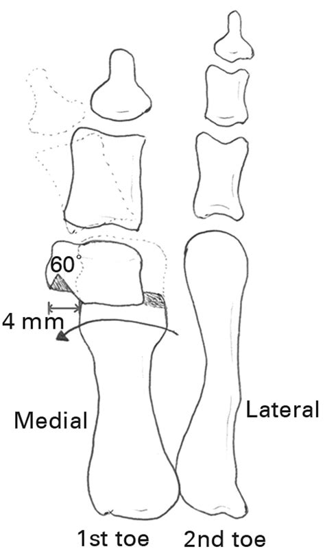 Distal metatarsal osteotomy for hallux varus following surgery for ...