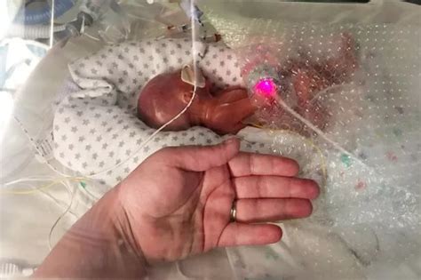 Miracle baby born weighing just over 1lb with translucent skin and ...