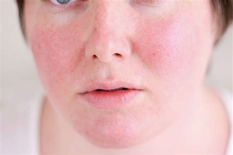 Heat Rash: 10 Heat Rash Symptoms