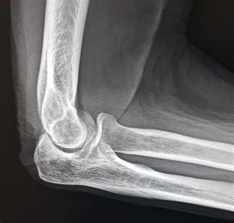 How to fix this elbow please. (Tips on correcting lateral elbow) : r/Radiology