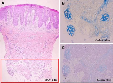 Pathology of a 5-year-old male who is diagnosed with atopic dermatitis ...