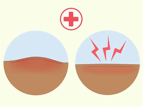 How to Care for a Wound After Stitches Are Removed