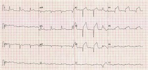 EKG de Sık Yapılan Hatalar Ve Trick Noktalar - Acil Çalışanları