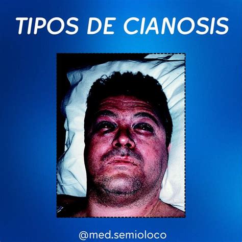 Tipos de Cianosis Semiología | Víctor Rodriguez Botero - @med.semioloco ...