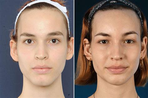 Dr zukowski facial feminization surgery – Telegraph