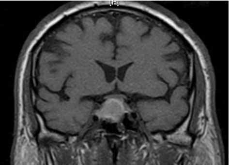 Pituitary Tumor Optic Chiasm