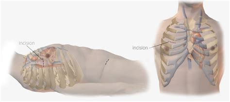 Mini-Thoracotomy | Minimally Invasive Heart
