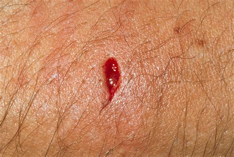 Dog bite wound on the forearm of a woman - Stock Image - M330/0627 - Science Photo Library