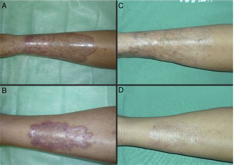 Photodynamic Therapy for Necrobiosis Lipoidica: Successful Treatment in a Series of 4 cases ...