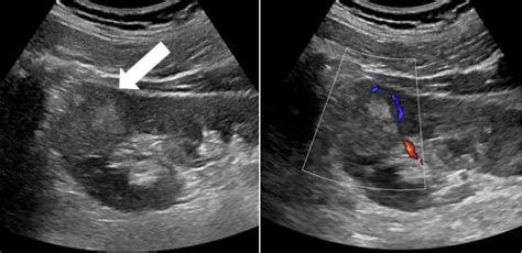 CEUS shows kidney mass is benign after CT suggests cancer ...