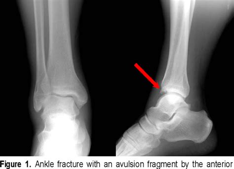 Figure 1 from Treatment of Anteroinferior Tibiofibular Ligament ...