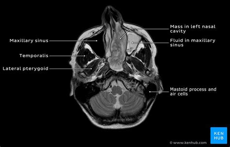 [DIAGRAM] Diagram Of Sinuses Mri - MYDIAGRAM.ONLINE