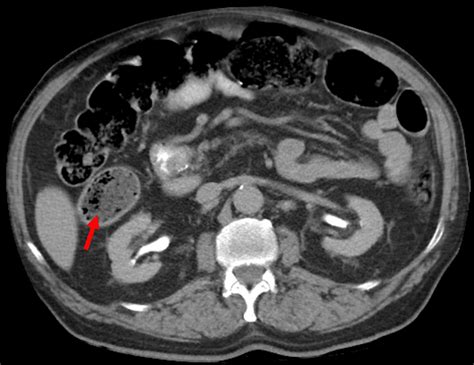 Cureus | Cecal Diverticulitis in a Geriatric Patient