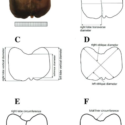 Measurements of the liver in the anterior projection: (A) diaphragmatic... | Download Scientific ...