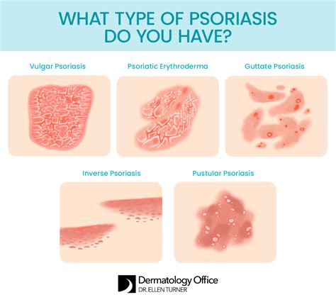How Psoriasis Is Treated, 54% OFF | wcigco.netfirms.com