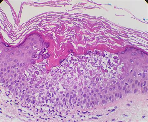 Hyperkeratosis Epidermolytic What Is Diagnosis