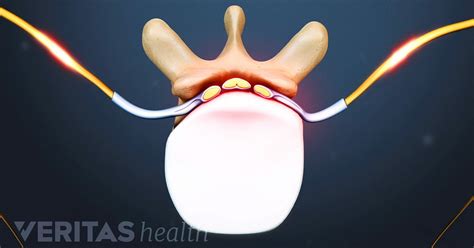 Thoracic Disc Herniation Symptoms