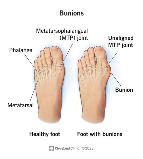 Bunions: Symptoms, Causes, & Treatment