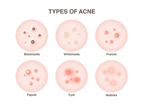 Types and causes of Acne (Part 2) — Skin& Medical Aesthetic Clinic