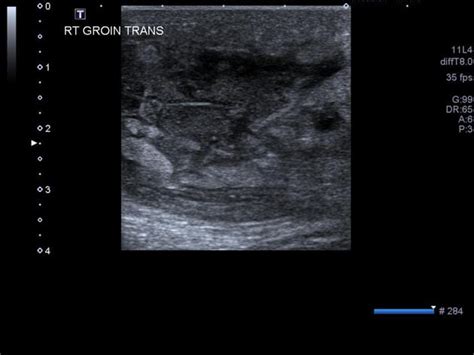 Submandibular Abscess Ultrasound